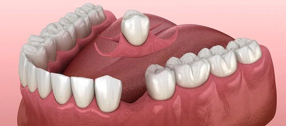 single-tooth-denture-options.jpg copy.jpg