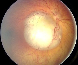 Fundus_retinoblastoma.jpg