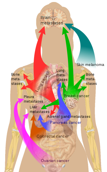 374pxMetastasis_sites_for_common_cancers.svg.png