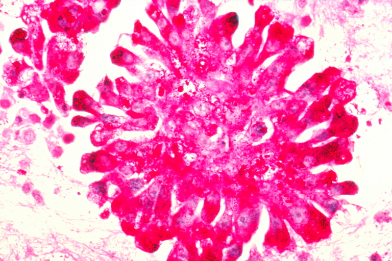 Ewing_sarcoma_cells.png