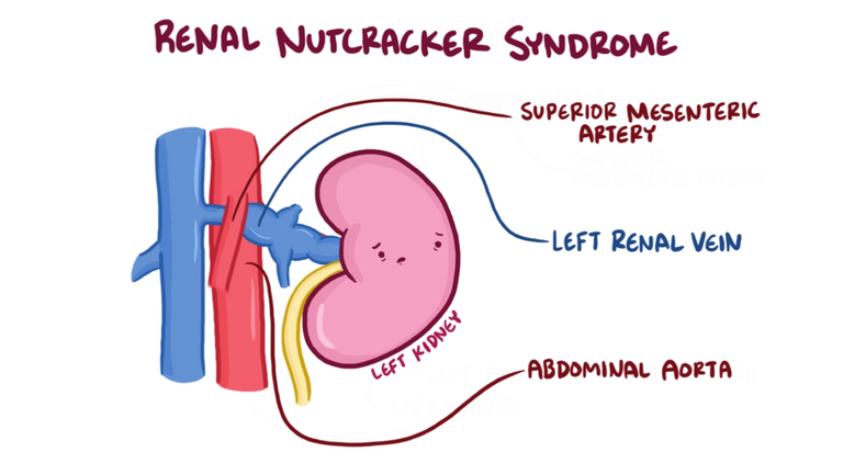 1280px-Nutcracker_Syndrome_Anatomy.png