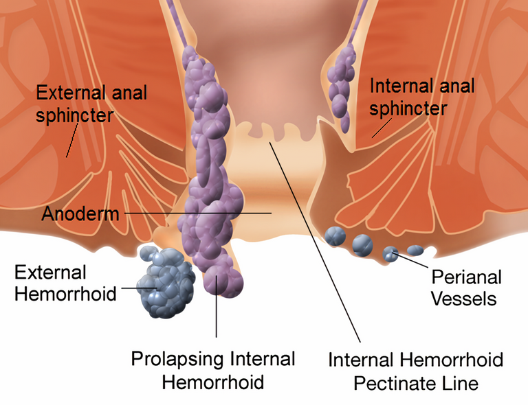 Internal_and_external_hemorrhoids.png