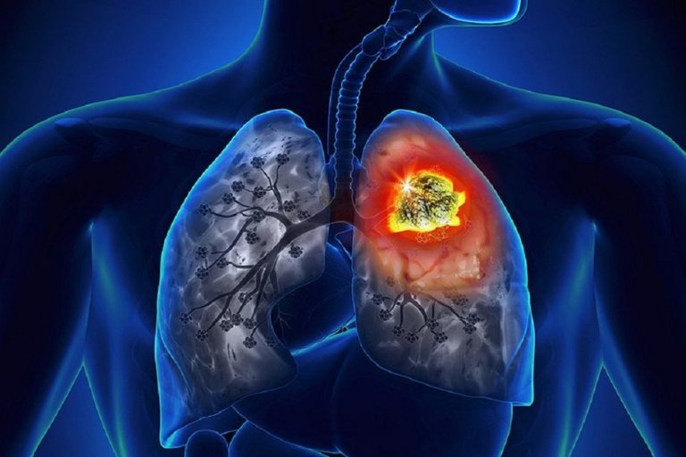 lung_cancer_570_850.jpg