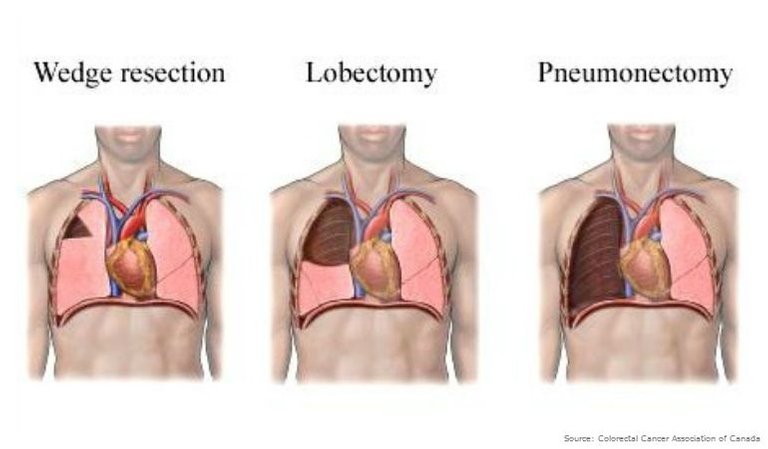 lung-metastases-diagnosis-prognosis-treatment-within-lung-cancer-surgery-recovery-time.jpg