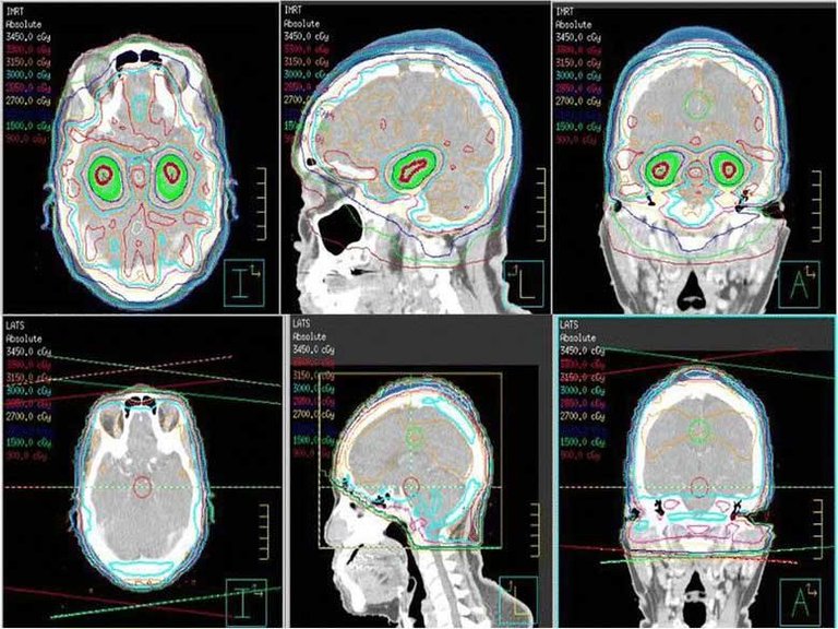 whole-brain-radiation-therapy-avoids-hippocampus-vs-standard-radiation-enalrge.jpg