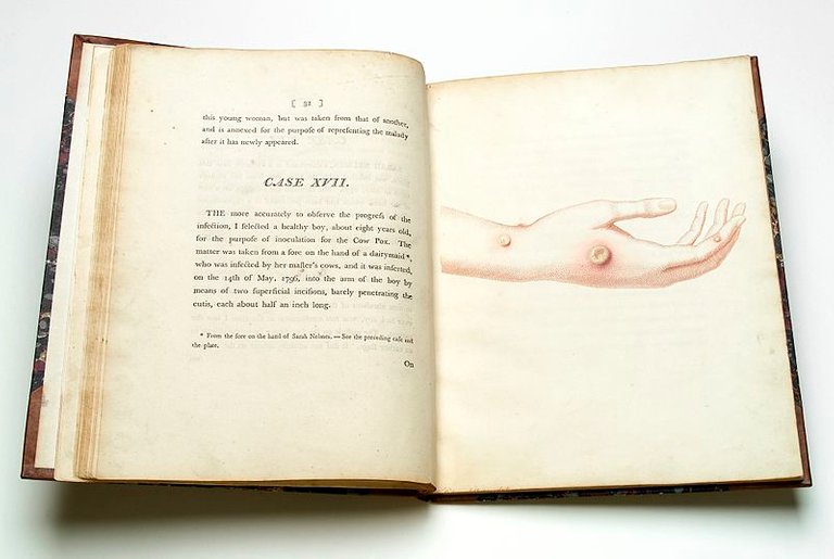 800px-The_hand_of_Sarah_Nelmes_infected_with_the_cowpox._Wellcome_L0043483.jpg