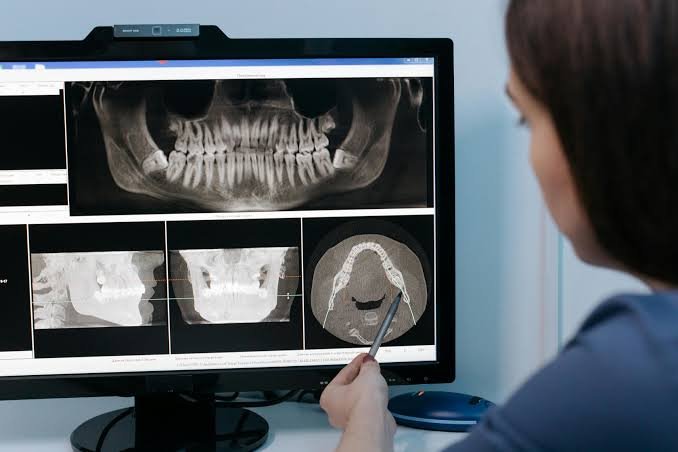 Dental X-Rays  ( Radiographs)