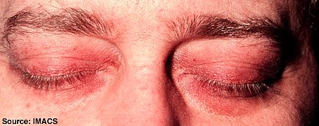 454px-Dermatomyositis10.jpg