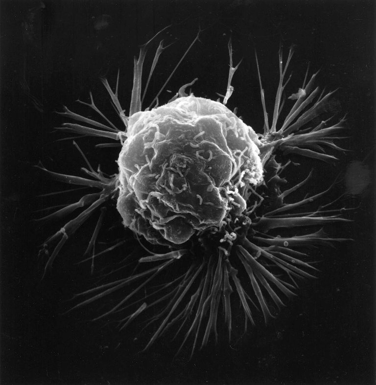 Breast_cancer_cell_(2).jpg