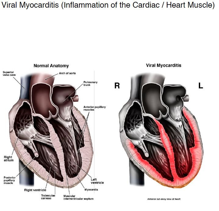 Myocarditis.jpg