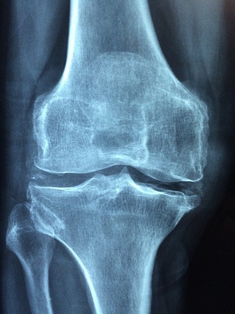 knee1406964_640 1.jpg