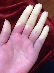 Raynauds.jpg