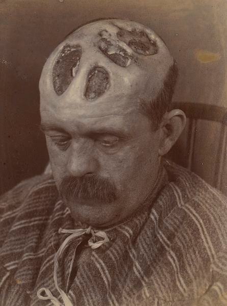 Tertiary_syphilitic_ulceration_of_the_scalp_Wellcome_L0062303.jpg