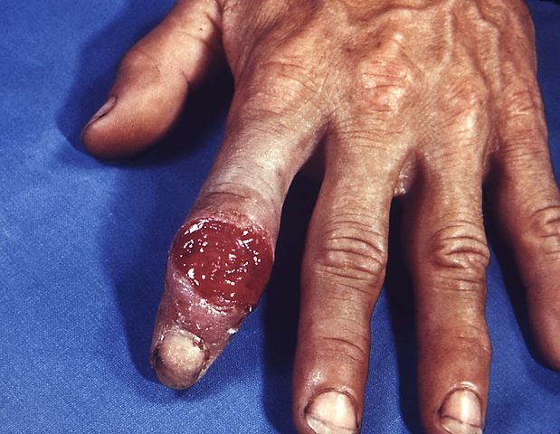 619pxExtragenital_syphilitic_chancre_of_the_left_index_finger_PHIL_4147_lores.jpg