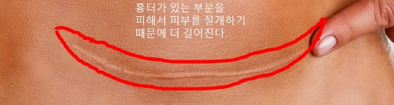 임신준비-제왕절개-흉터-재수술2.jpg.jpg