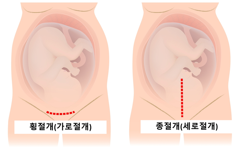 -제왕절개-흉터-절개법