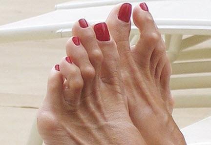 Hammertoes.jpg