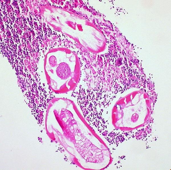 Pinworms_(Enterobiasis)_in_the_Lumen_of_the_Vermiform_Appendix_(8612815555).jpg