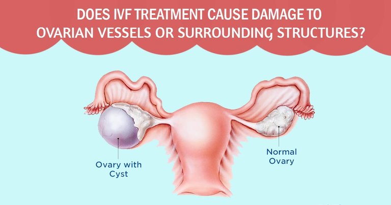 Does IVF Treatment Cause Damage to ovarian vessels or surrounding structures