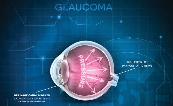 Glaucoma