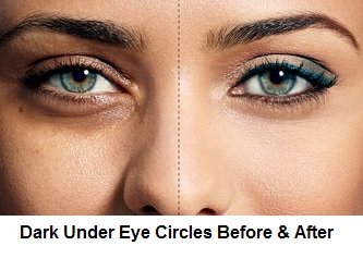 Dark_Under_Eye_Circles_Before_And_After