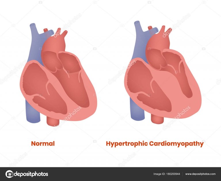 depositphotos_180200944_stock_illustration_normal_heart_and_hypertrophic_heart.jpg