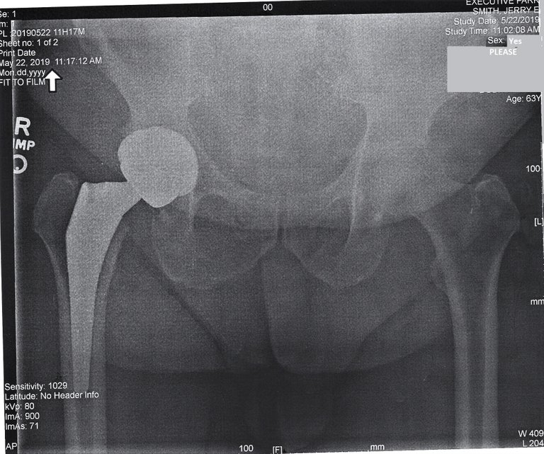 new_hip_1_cleaned