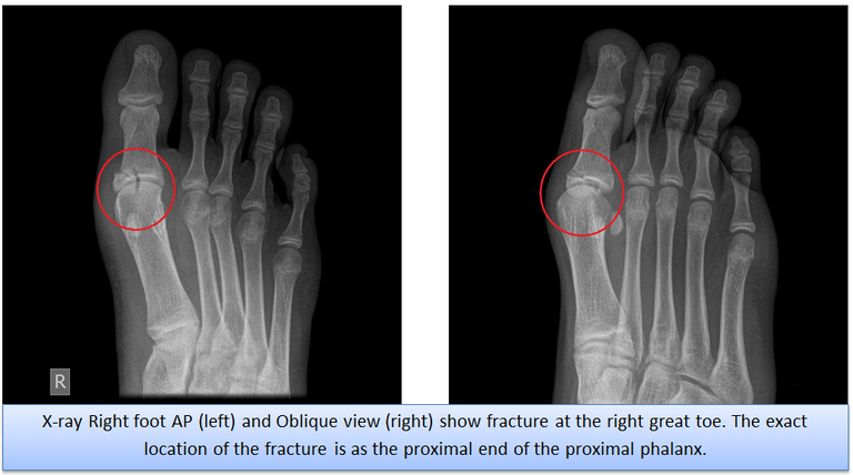 x_ray_right_foot.png