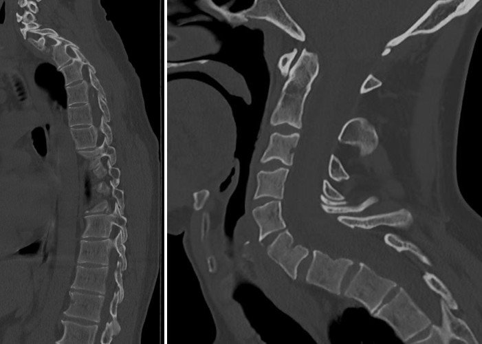 Left : My spinal column / Right : my cervical vertebrae
