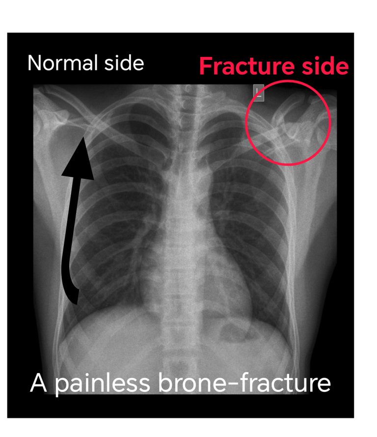 A Painless Bone-fracture! | Random Chamber Talk | December 31, 2024