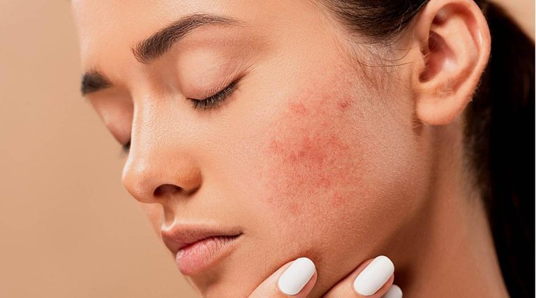 pixabay_acne_pimples_1200.jpg