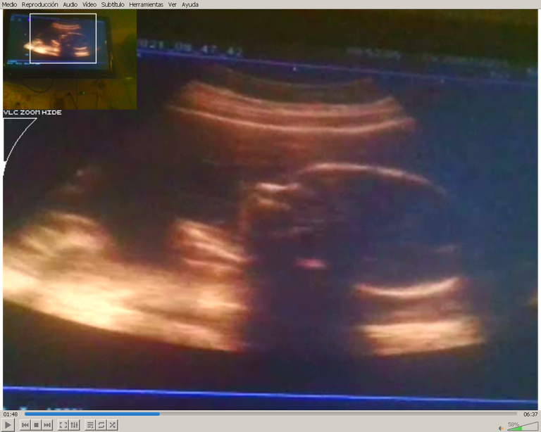 A screen shot of the latest ultrasound of our Baby <3