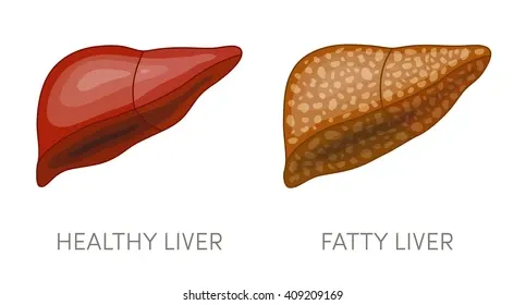 fatty-liver-disease-vector-illustration-260nw-409209169.webp