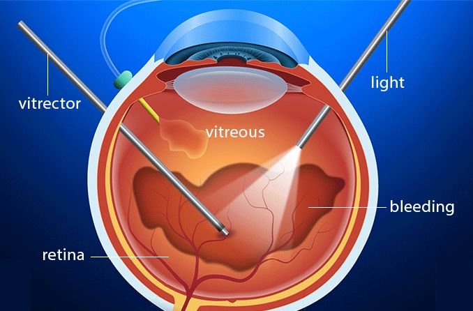 vitreous-hemorrhage-678x446.jfif