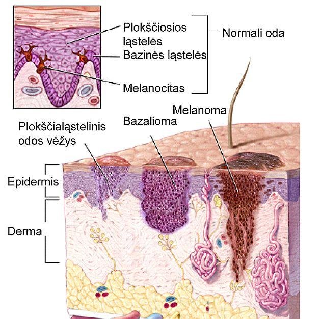 Odos_vėžio_formavimasis.jpeg