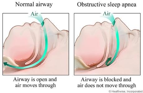 snoring-problems.jpg