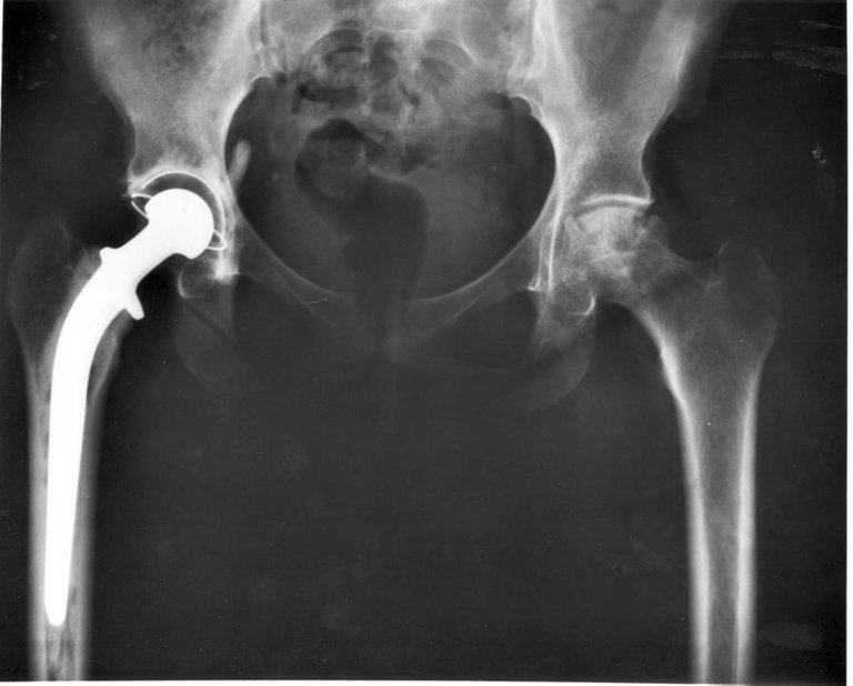 Hip_replacement_Image_3684-PH.jpeg