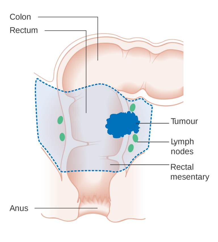 2000px-Diagram_showing_the_area_removed_for_a_rectal_cancer_CRUK_286.svg.png