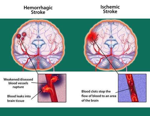 types-of-stroke-web.jpg