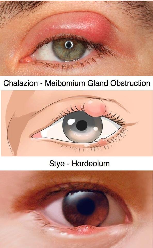 chalazion-stye-hordeolum-633x1024.jpg