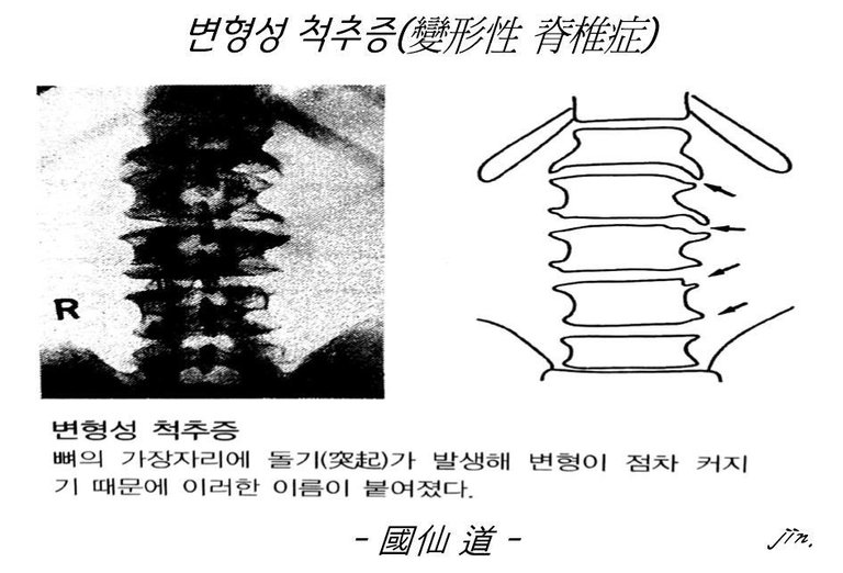 변형성 척추증1.jpg