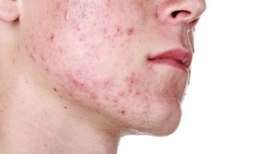 TeenAcne-500x300.jpg