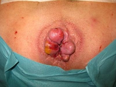 Hemorrhoids-4.jpg