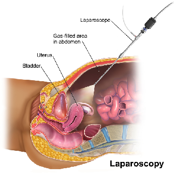 laparoscopy.png