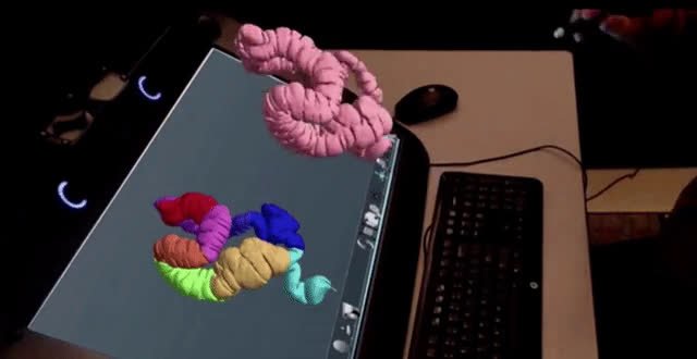 aneurysm.mp4