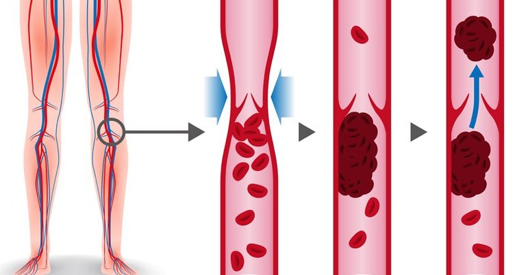 Deep vein thrombosis