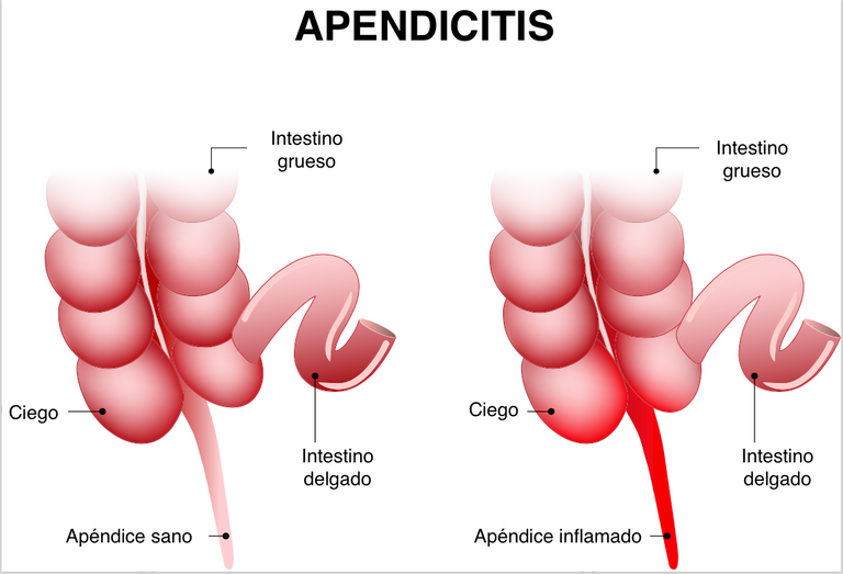 apendicitis-1.png