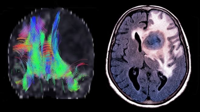 _99437574_c0373096-glioblastoma_dti_and_mri_scans-spl.jpg