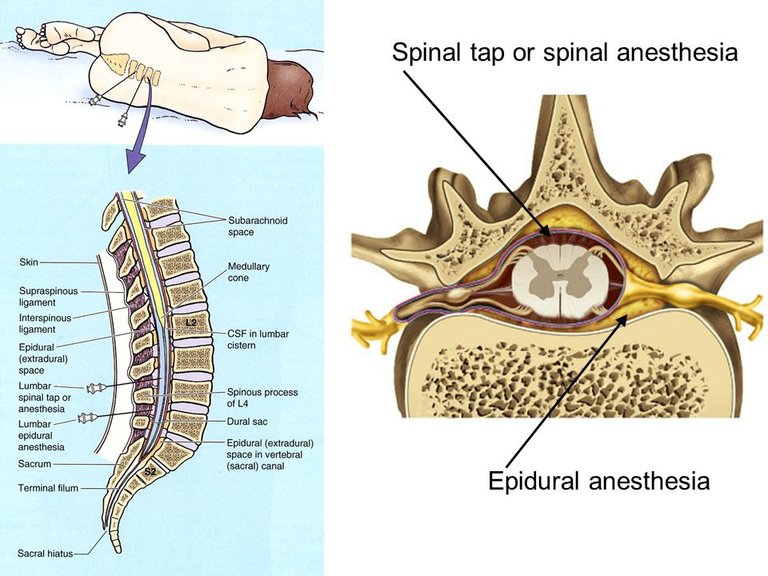 Spinal+tap+or+spinal+anesthesia.jpg