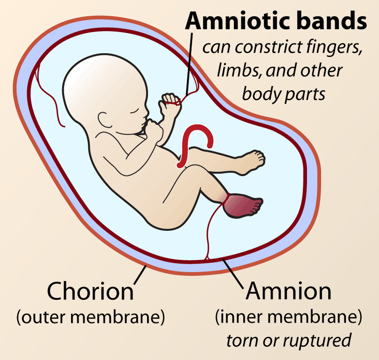 amniotic-band-syndrome-illustration.png